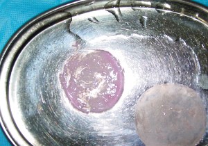 人造皮肤在西安开始临床应用外形像张饺子皮