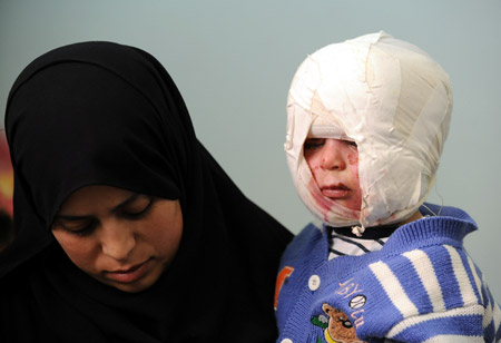 Photo taken on January 28, 2009 shows two-year-old Palestinian boy Hassan Abo Sfya at the Shifa hospital in Gaza City after he was wounded during the Israeli operation of Cast Lead on Gaza Strip.