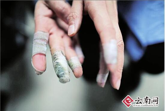 Fingers are wrapped with adhesive plaster.